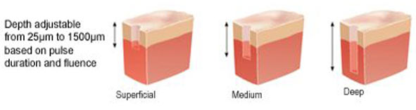 ProFractional Treatment Overview